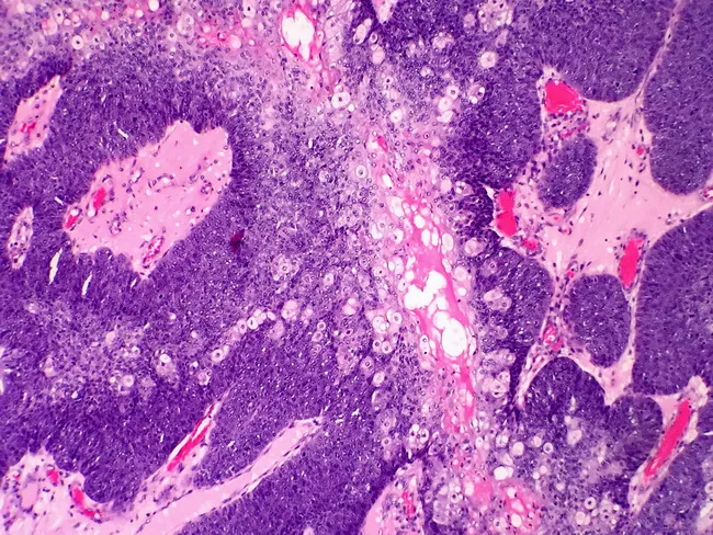 Sebaceous Carcinoma