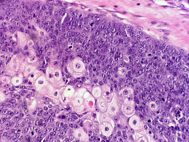 Sebaceous Carcinoma