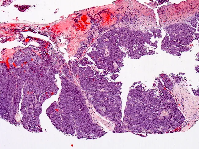 Sebaceous Carcinoma