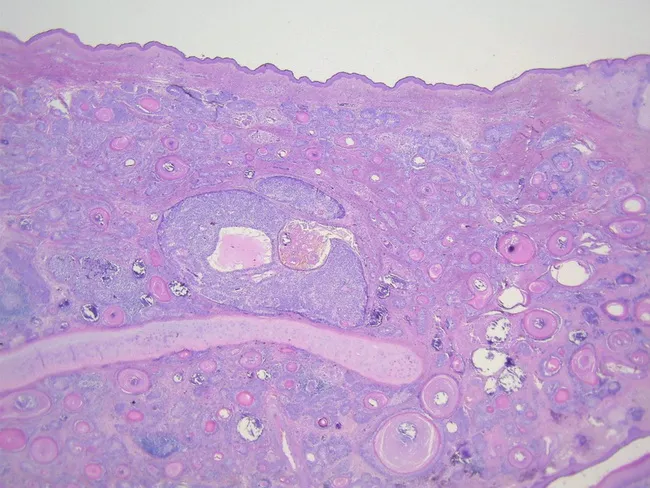 Sebaceous Carcinoma
