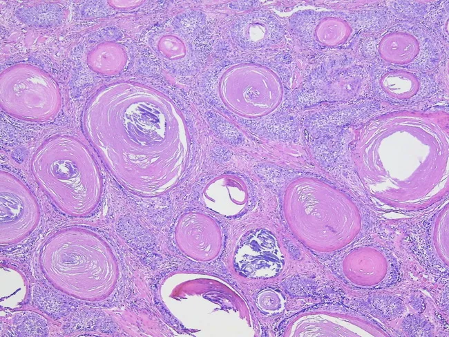 Sebaceous Carcinoma