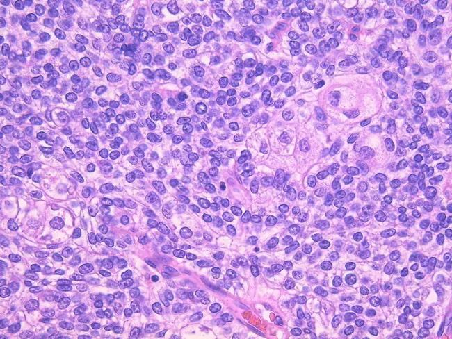 Sebaceous Carcinoma