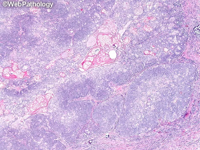 Sebaceous Carcinoma