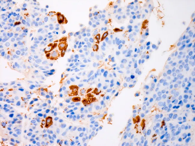 Sebaceous Carcinoma : Adipophilin