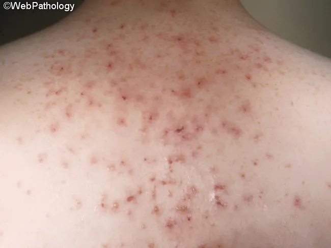 Dermatitis Herpetiformis