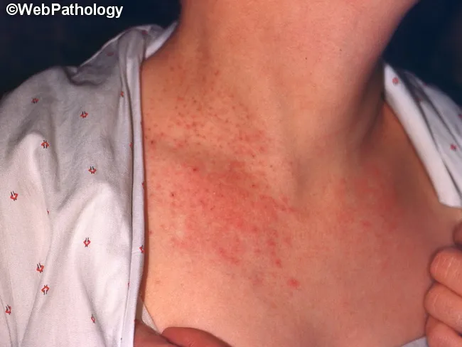 Darier Disease