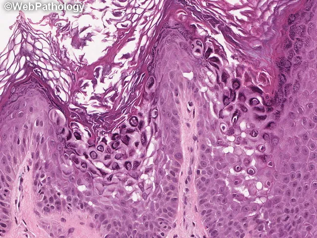 Darier Disease