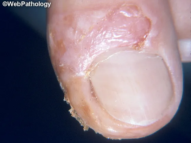 Impetigo : Paronychial