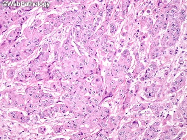 Breast Cancer : Luminal B