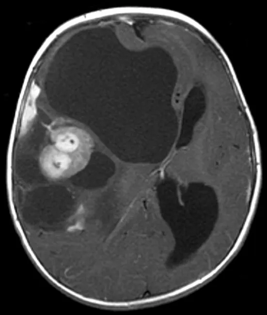 Desmoplastic Infantile Ganglioglioma