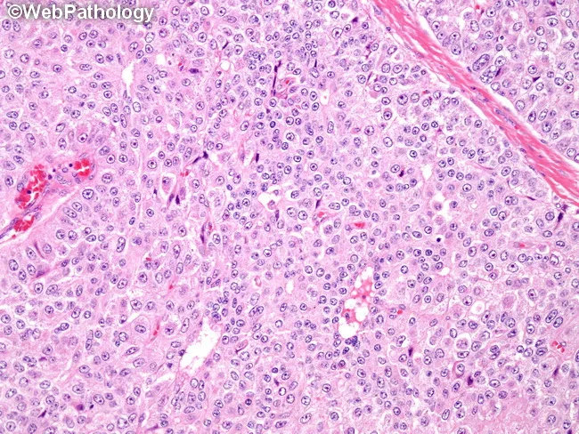 Breast Cancer : Luminal B