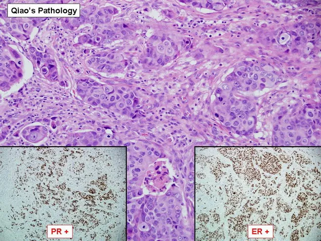 Breast Cancer : Luminal B