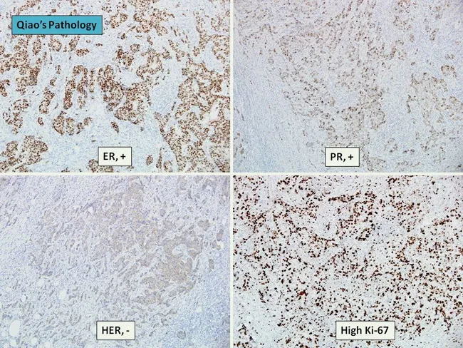 Breast Cancer : Luminal B