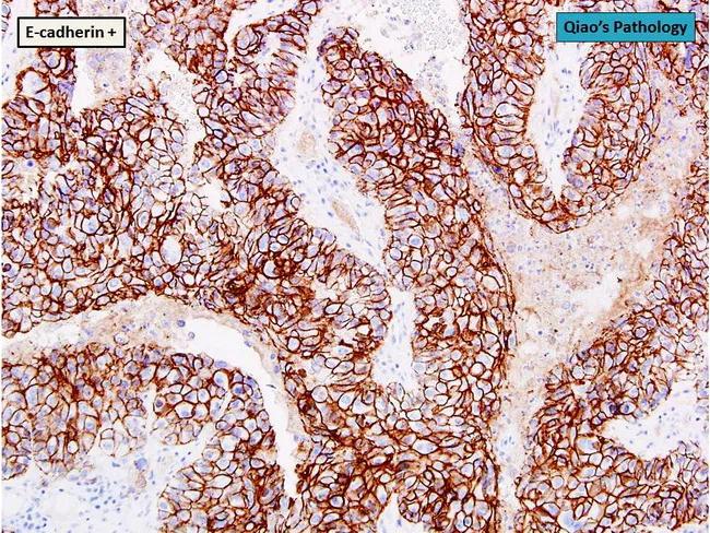 Breast Cancer : Luminal B