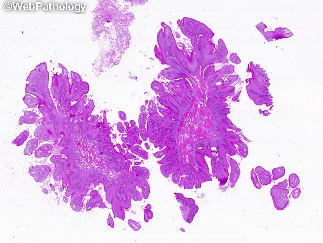 Condyloma Acuminata : Microscopic