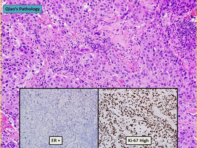 Breast Cancer : Luminal B