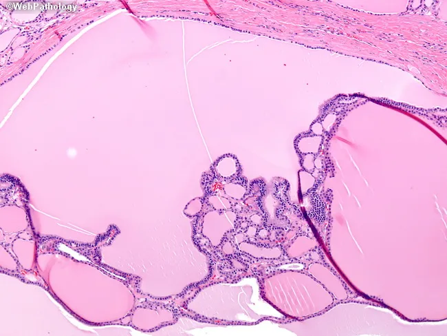 Multinodular Goiter