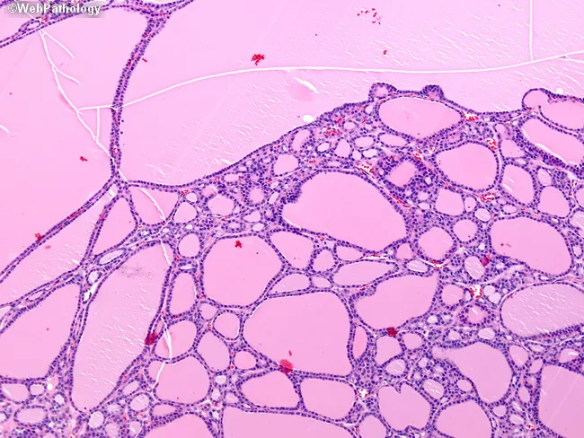 Multinodular Goiter