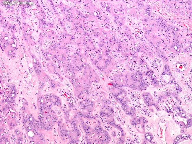 Hyalinizing Trabecular Adenoma