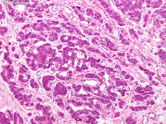 Hyalinizing Trabecular Adenoma