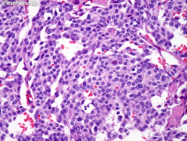 Medullary Thyroid Carcinoma