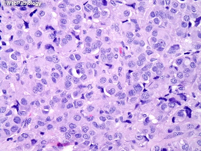 medullary thyroid carcinoma semaglutide New Research Challenges Fears of Semaglutide-Linked Cancer Risk I received my first Wegovy