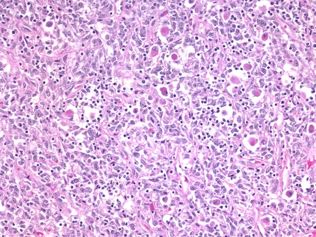 Phyllodes Tumor : High-grade with Rhabdomyosarcoma