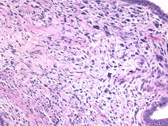 Phyllodes Tumor : High-grade with MFH-like areas.