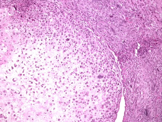 Phyllodes Tumor : High-grade with Chondrosarcoma