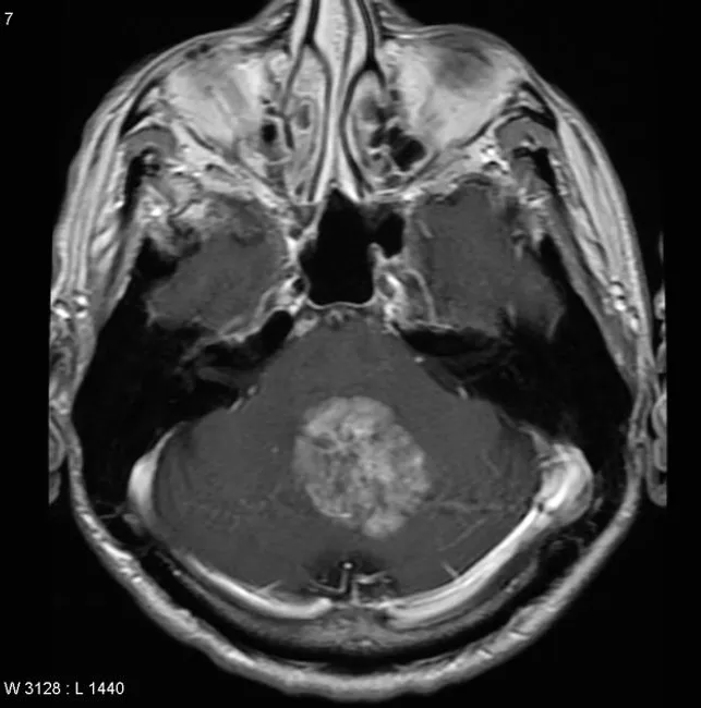 サーナイト　mri Ultra-high-resolution MRI reveals migraine brain changes