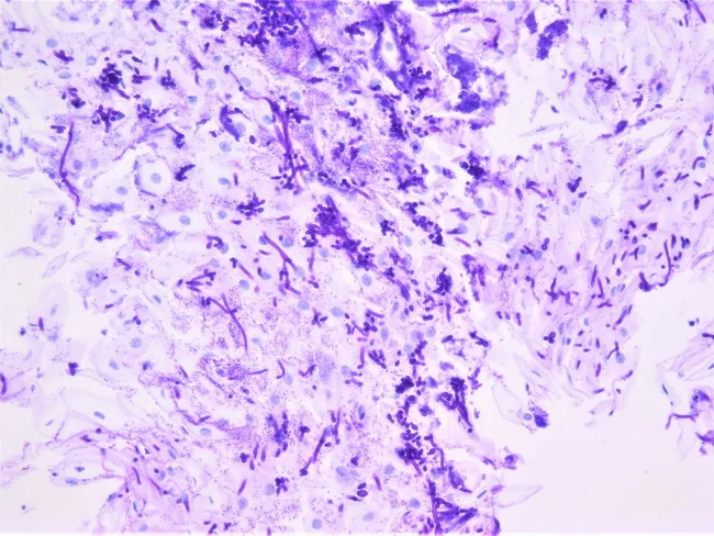 Candida Esophagitis : PAS