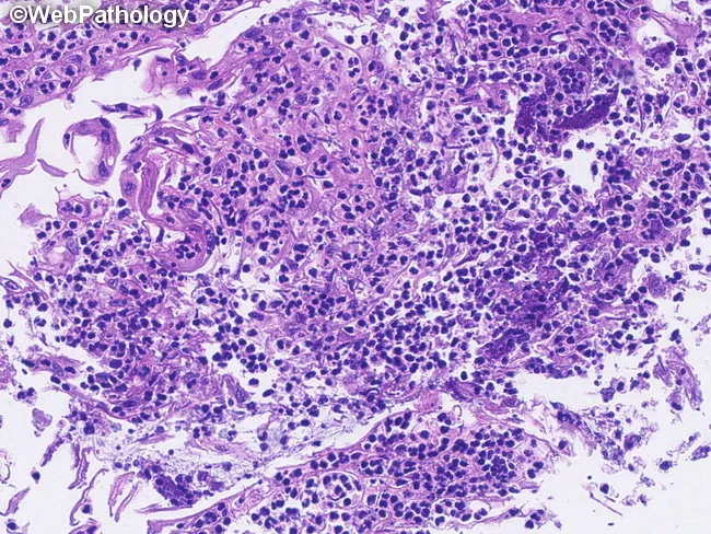Candida Esophagitis