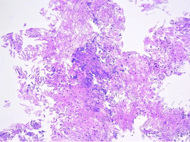 Candida Esophagitis