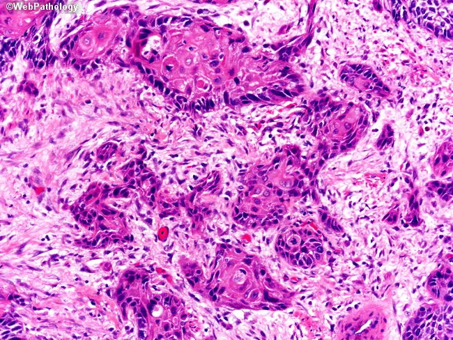 Squamous Cell Carcinoma of Esophagus