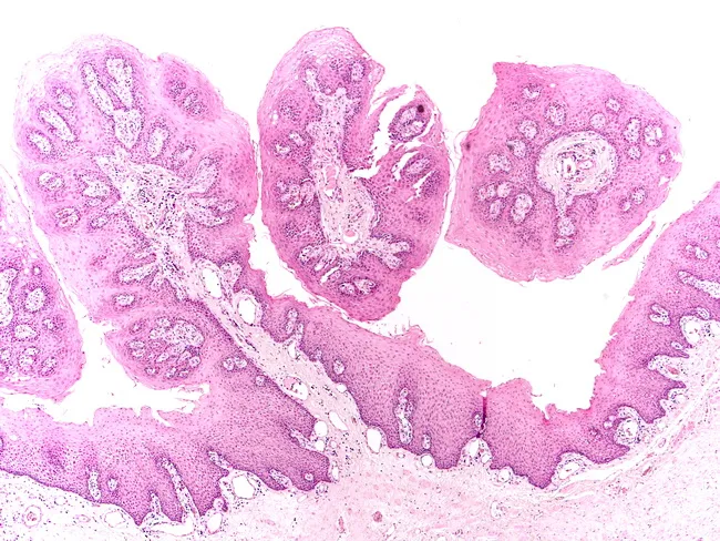 squamous papillomatosis pathology outlines