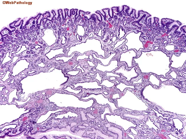 Fundic Gland Polyp