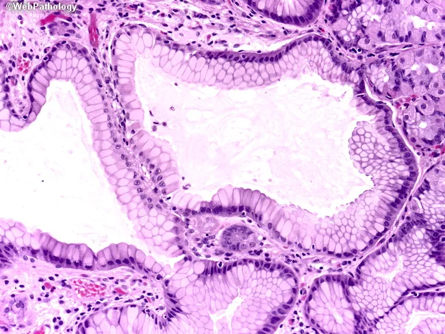 Fundic Gland Polyp