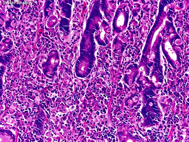 Gastric Adenocarcinoma, Diffuse Type (Linitis Plastica; Signet Ring ...