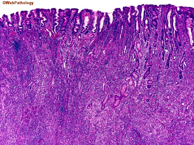 Gastric Adenocarcinoma, Diffuse Type (Linitis Plastica; Signet Ring ...
