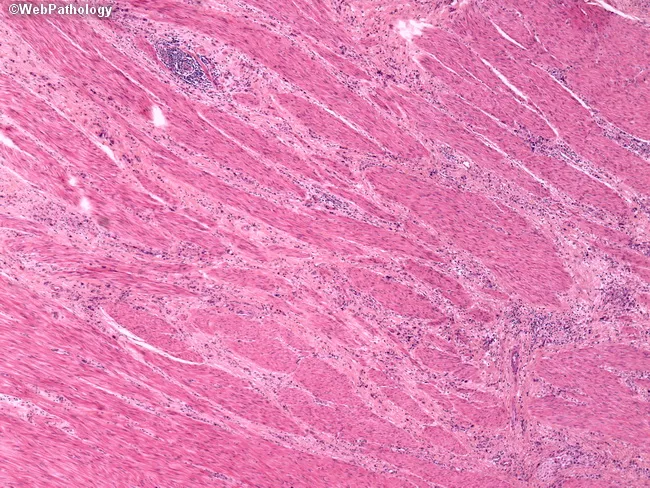 Gastric Adenocarcinoma, Diffuse Type (Linitis Plastica; Signet Ring ...