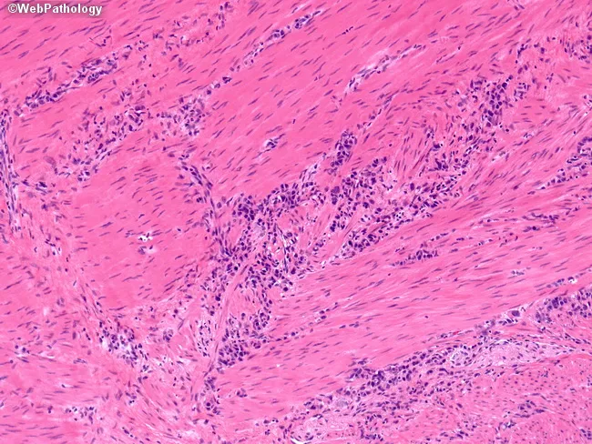 Gastric Adenocarcinoma, Diffuse Type (Linitis Plastica; Signet Ring ...