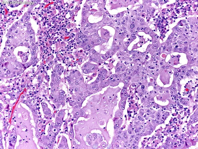Adenosquamous Carcinoma