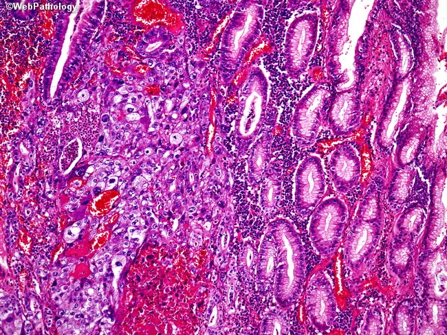 WAT IS CHORIOCARCINOMA visual data 7