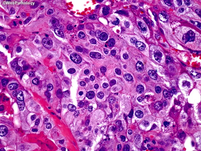 CHORIOCARCINOMA MEDLINEPLUS MEDICAL ENCYCLOPEDIA visual data 6