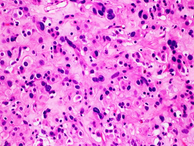Epithelioid GIST