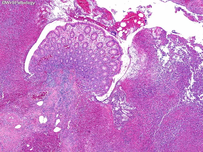 Acute Appendicitis
