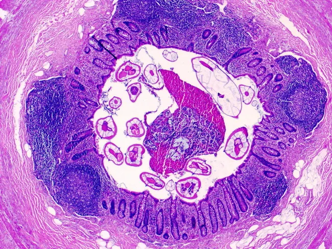Enterobius vermicularis