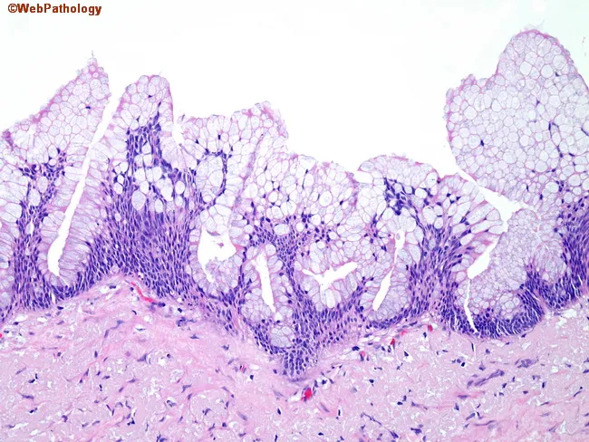 Pseudomyxoma Peritonei : Case 1