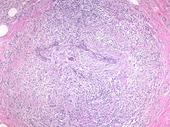 breast granulomatous mastitis icd 10