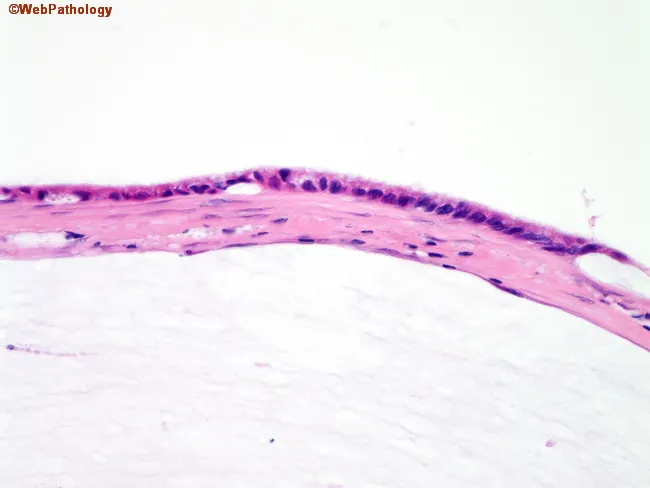 Pseudomyxoma Peritonei : Case 2